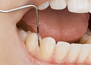 歯周基本治療クリーニング
