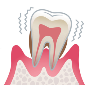歯周炎（重度）